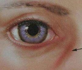 眼輪匝肌 眼輪匝肌