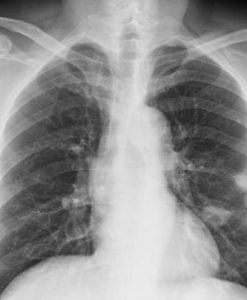 肺部影像