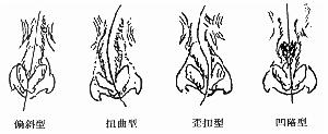 鼻中隔偏曲