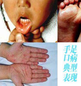手口足病 手口足病