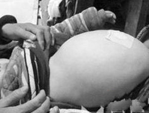 戈謝氏病 戈謝氏病