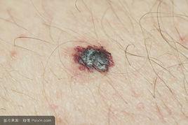 惡性雀斑 惡性雀斑