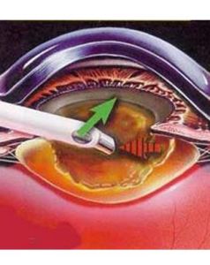 生殖器念珠菌病