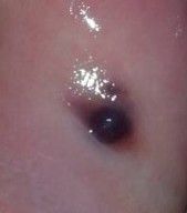 口腔血泡 口腔血泡