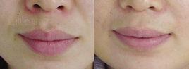 嘴唇修唇術 嘴唇修唇術