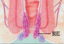 小兒脫肛 小兒脫肛