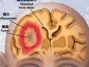 腦垂體腫瘤