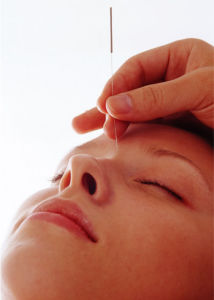 針灸減肥操作簡便