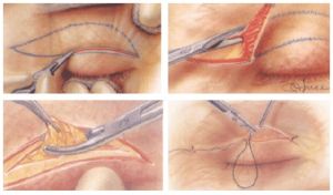割雙眼皮 割雙眼皮
