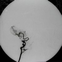 踇長伸肌 踇長伸肌