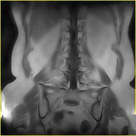 神經源性腫瘤 神經源性腫瘤