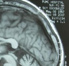 肌萎縮側索硬化症