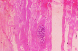 肉孢子蟲病 肉孢子蟲病