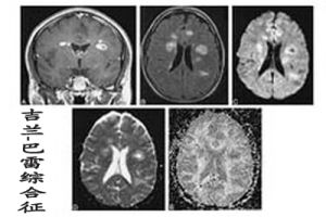 古蘭-巴雷綜合徵 古蘭-巴雷綜合徵