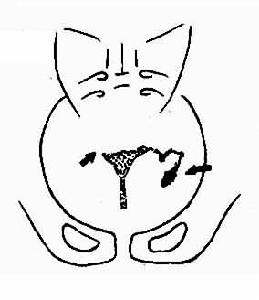 女性生殖器官結核