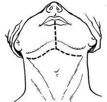 全下頜骨切除術