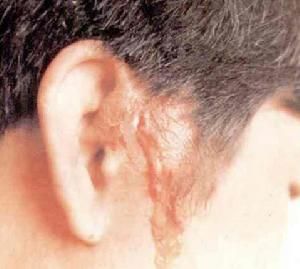 先天性耳前瘺管