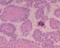 甲狀腺乳頭癌 甲狀腺乳頭癌