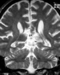 胼胝體發育不良 胼胝體發育不良