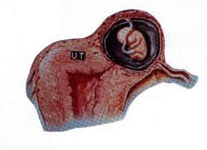 輸卵管膨出