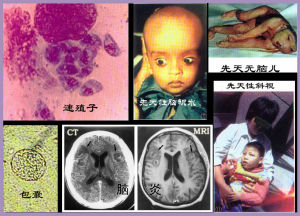 先天性弓形體感染