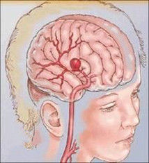 海綿狀腦血管瘤