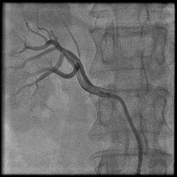 繼發性高血壓病 繼發性高血壓病