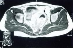 盆腔囊腫