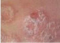 斑塊狀銀屑病 斑塊狀銀屑病