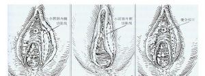 小陰唇整形術