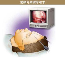 內窺鏡除皺術 內窺鏡除皺術