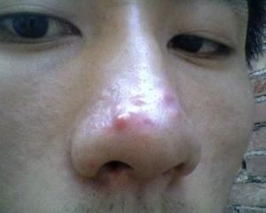 鼻子長痘 鼻子長痘