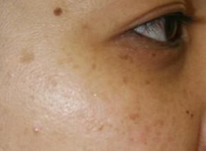 眼角長斑 眼角長斑