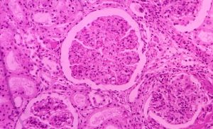 分流性腎炎 分流性腎炎