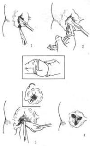 混合痔切除術 混合痔切除術