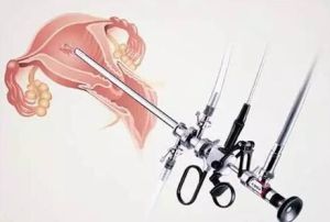 診斷性刮宮 診斷性刮宮