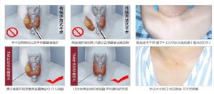 TMI針式定位微創術 TMI針式定位微創術