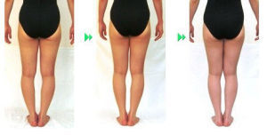 O型腿塑形術 O型腿塑形術