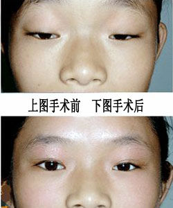 上眼瞼下垂 上眼瞼下垂