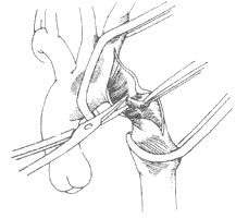 先天性主動脈縮窄