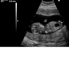 超音波顯示出一個患上唐氏綜合徵與巨膀胱的胎兒。