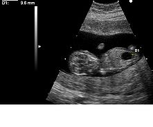 超音波顯示出一個患上唐氏綜合徵與巨膀胱的胎兒。