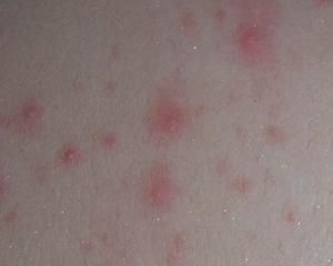 小兒過敏性蕁麻疹 小兒過敏性蕁麻疹