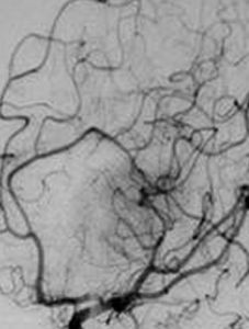 血管畸形 血管畸形