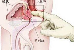 前列腺肥大中醫療法 前列腺肥大中醫療法