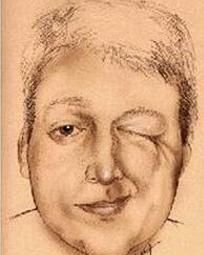 面肌痙攣 面肌痙攣