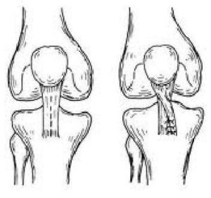 髕骨脫位 髕骨脫位