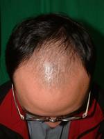 男性型禿髮 男性型禿髮