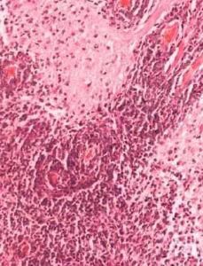 髓母細胞瘤 髓母細胞瘤