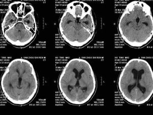 慢性腦積水 慢性腦積水